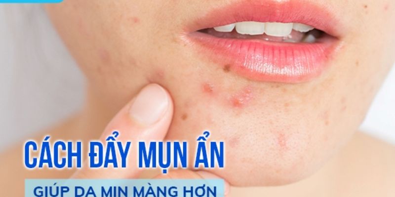 Cách đẩy nhân mụn an toàn và hiệu quả – Hướng dẫn chăm sóc da đúng cách